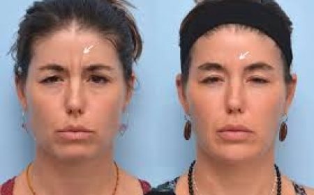 Botox for the First Time: What to Expect at the Best Aesthetic Clinic in Dubai