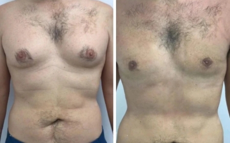 Why Choosing the Best Gynecomastia Surgeon in Dubai Can Help You Avoid Complications