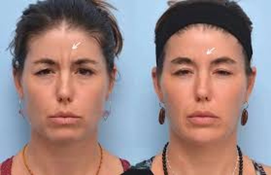 Botox for the First Time: What to Expect at the Best Aesthetic Clinic in Dubai