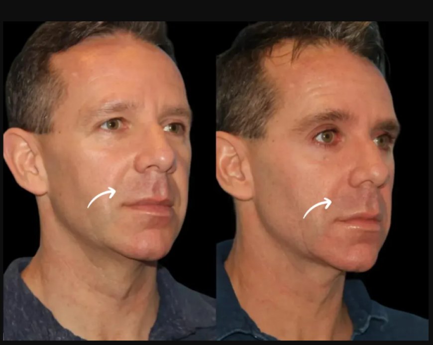 Discreet and Luxury Sculptra Fillers Treatments at Dubai’s Best Aesthetic Clinics