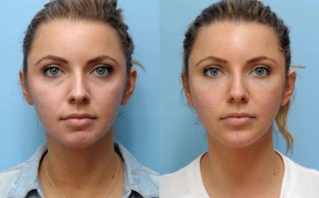 Best Aesthetic Clinics in Dubai for Thread Lift: Non-Surgical Facelift Solutions