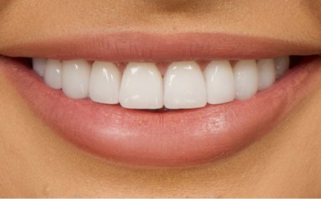 Are Dental Veneers Worth It for Minor Tooth Imperfections?