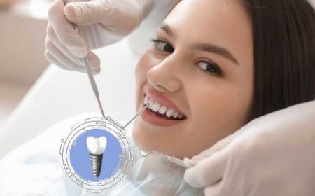A Clear Guide to Getting a Front Tooth Dental Implant