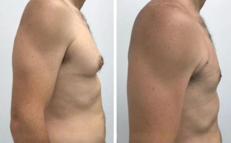 A Step-by-Step Guide to Gynecomastia in Dubai: From Consultation to Recovery