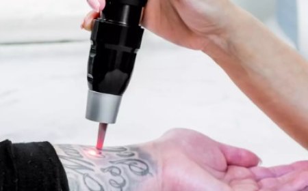 Laser Tattoo Removal in Islamabad: Everything You Need to Know