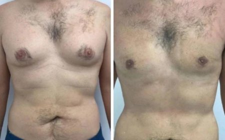 How Weight Loss Affects Gynecomastia in Dubai: What Patients Should Know about