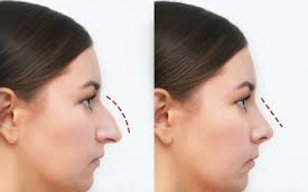 Shaping Confidence: The Complete Guide to Rhinoplasty